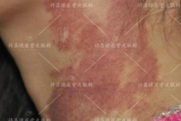 胎记算命图解：什么是红胎记？