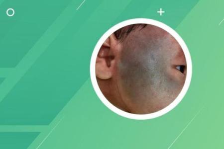面部不同位置的胎记算命