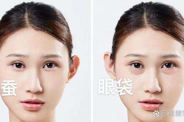 八字眼袋